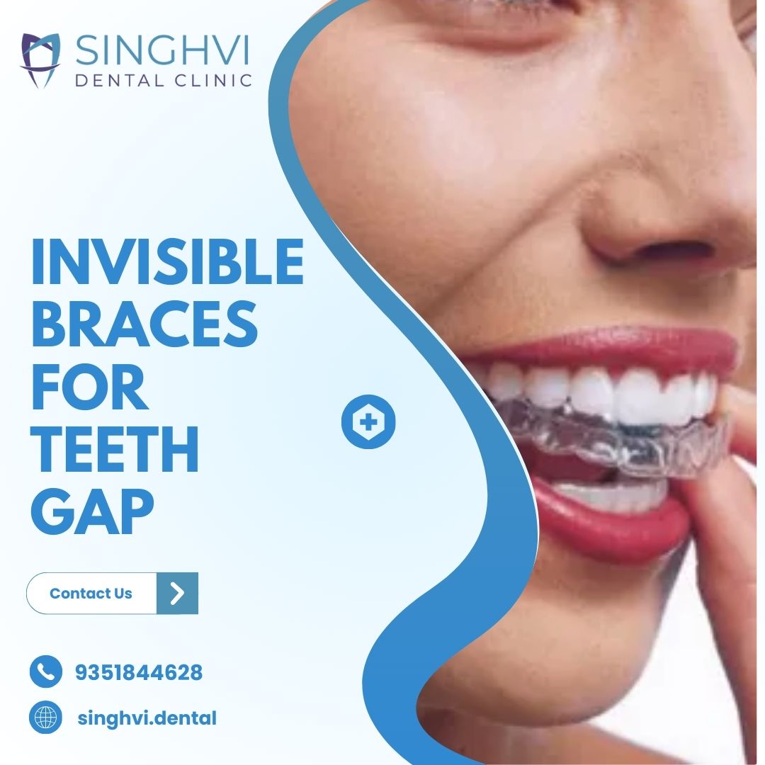 Invisible Braces For Teeth Gap| Singhvi Dental Clinic
